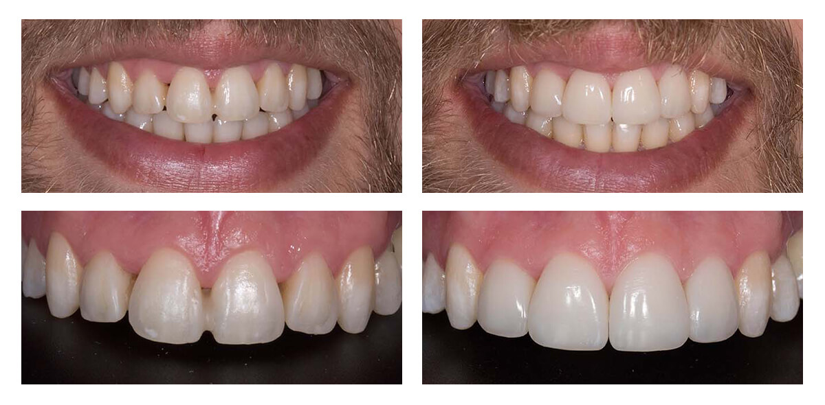 Billy goat transmission Unparalleled Estetinis dantų plombavimas - Antakalnio stomatologijos centras